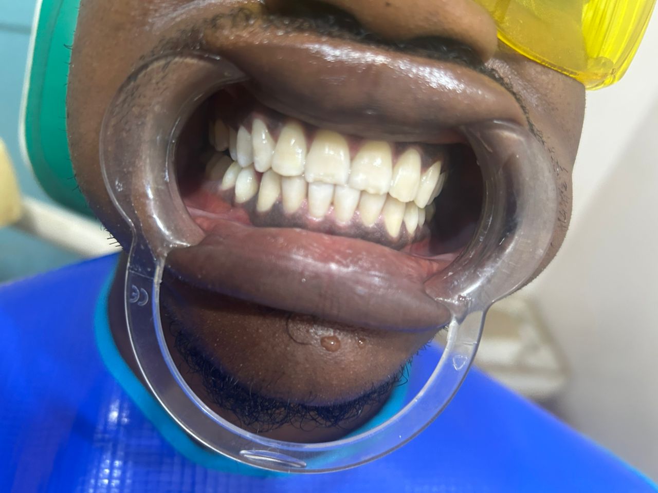 After teeth whitening treatment - stunning results